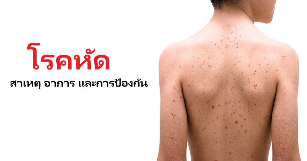 การระบาดของโรคหัดในประเทศไทย