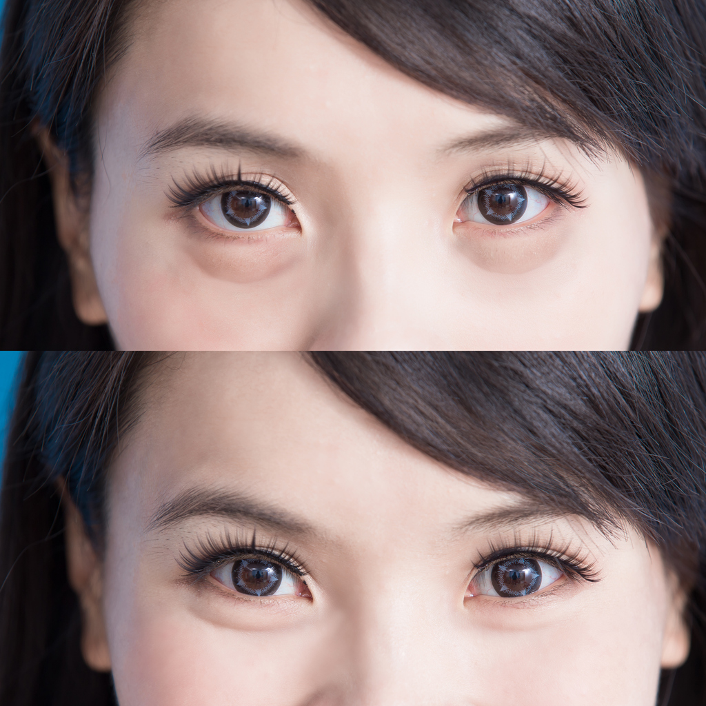 eye bag removal surgery