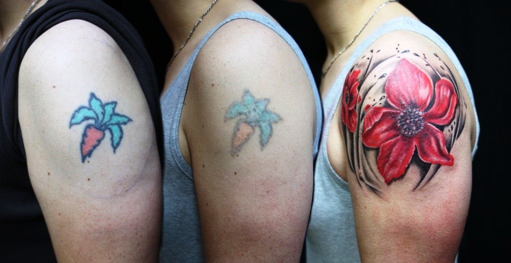 Tattoo removal, Remove Tattoo, Tattoo