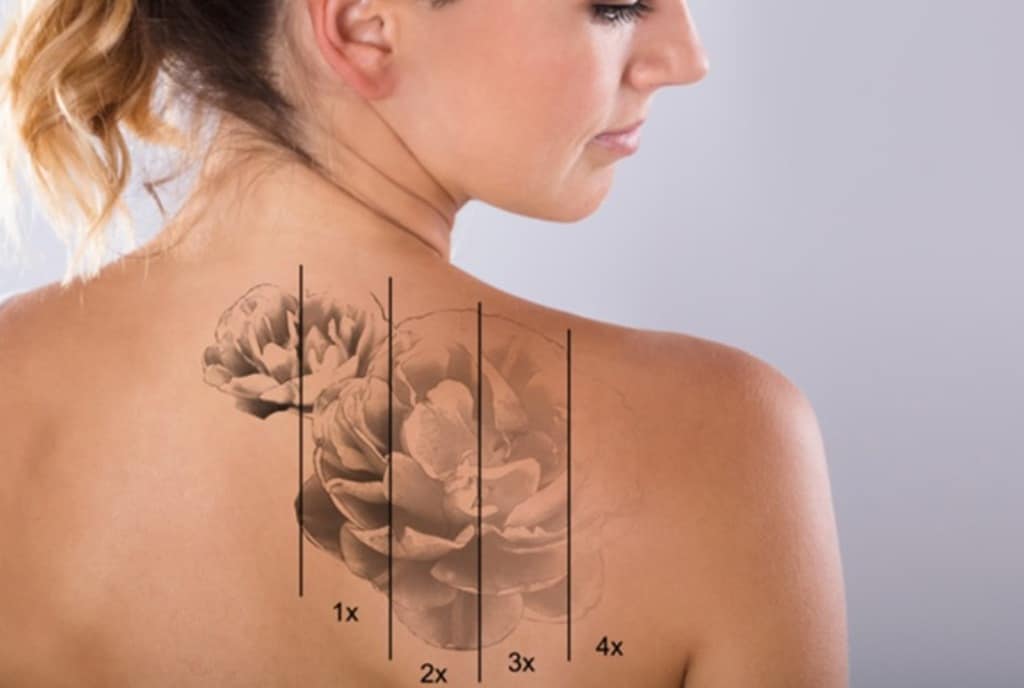 Trying to Remove a Tattoo at Home Can Do More Harm Than Good