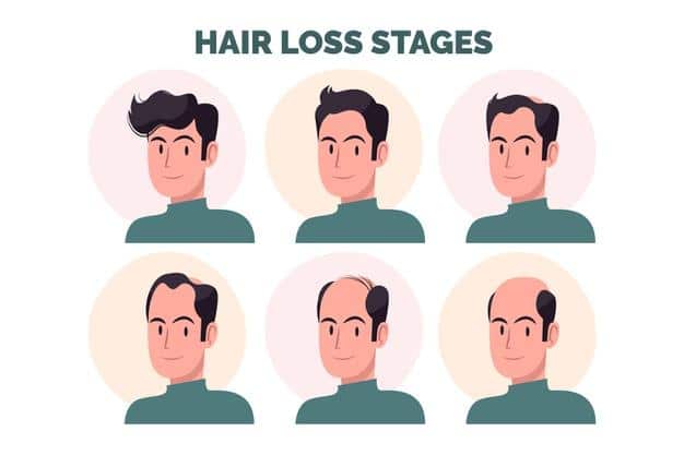 Hair Loss: How Do I Avoid Hair Fall at the Age Of Twenty? - Siam Scope Magazine Hair Loss: How Do I Avoid Hair Fall at the Age Of Twenty? - Siam Scope Magazine