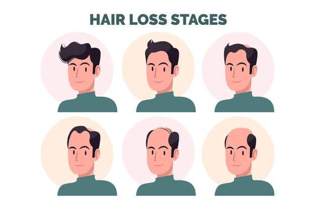 Hair Loss: How Do I Avoid Hair Fall at the Age Of Twenty?