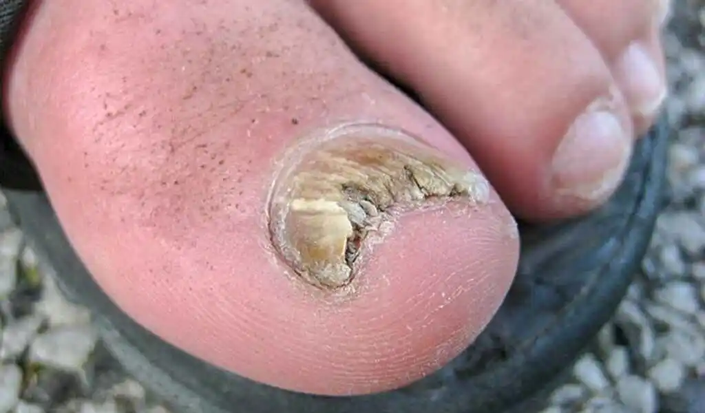 nail fungus