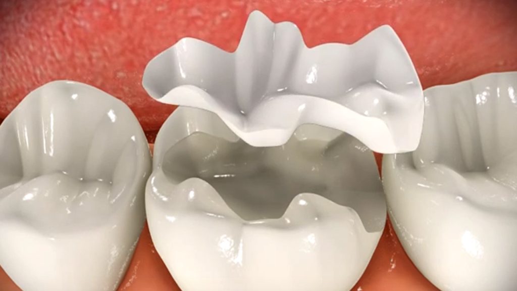 Tooth restoration