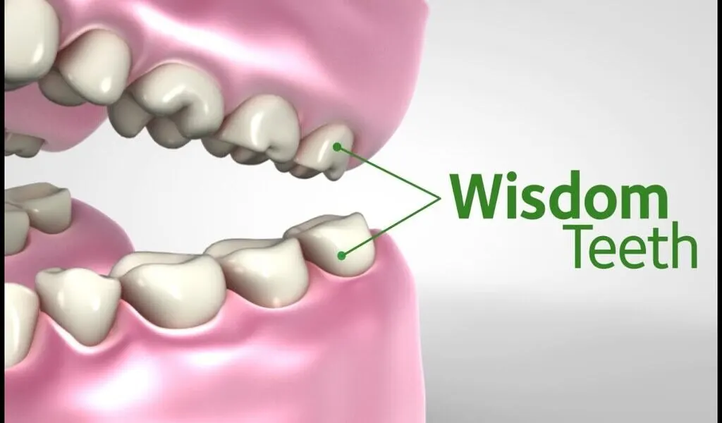 wisdom teeth