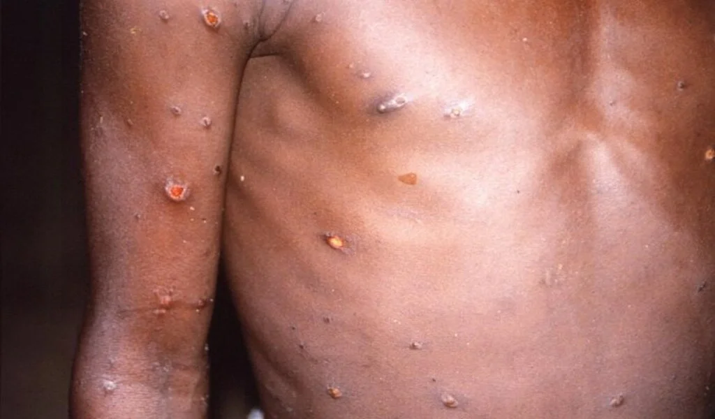As Monkeypox Cases Rise Abroad, State Asks Hospitals To Be On Alert