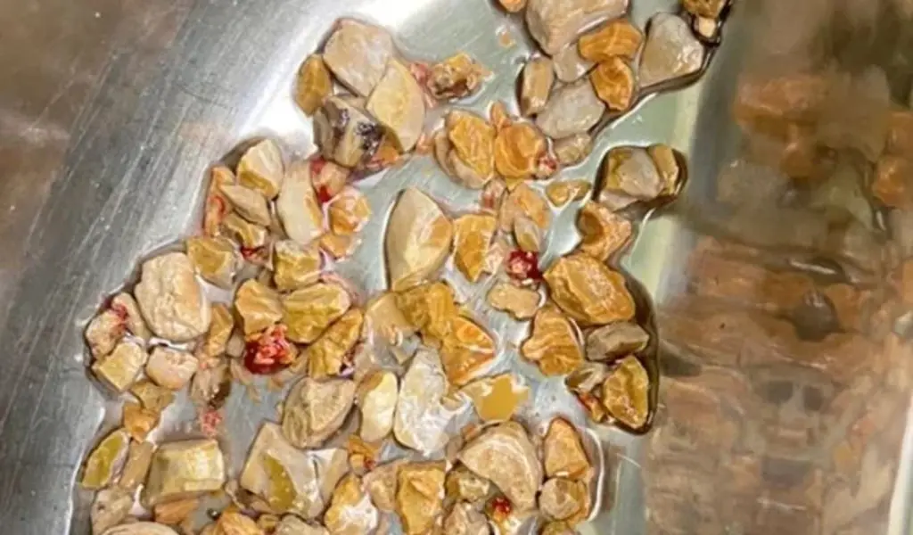 Indian Doctors Remove 206 Kidney Stones In 1 Hour From A 56-Year-Old Man