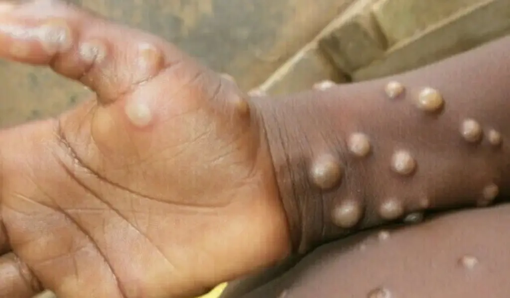 Pakistan On High Alert After Monkeypox Cases Detected In UK, US & Many Countries