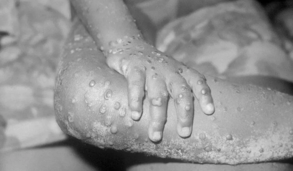 UK Stocking Up On Vaccines As Monkeypox Cases Rise To 20