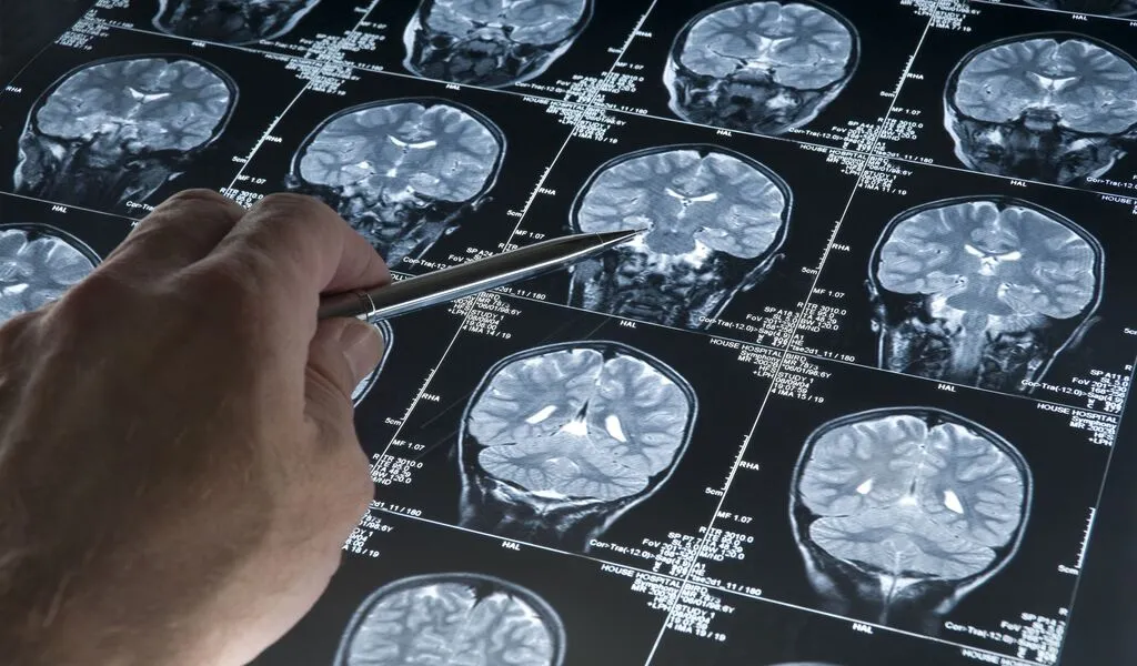 Alzheimer's Can Now Be Detected With Just One MRI Scan