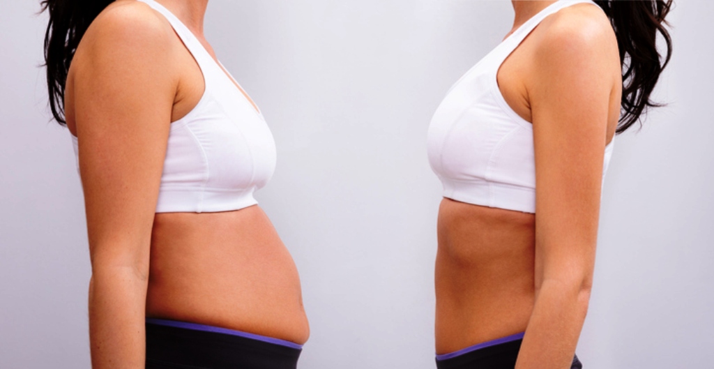 Having Liposuction and a Tummy Tuck at the Same Time