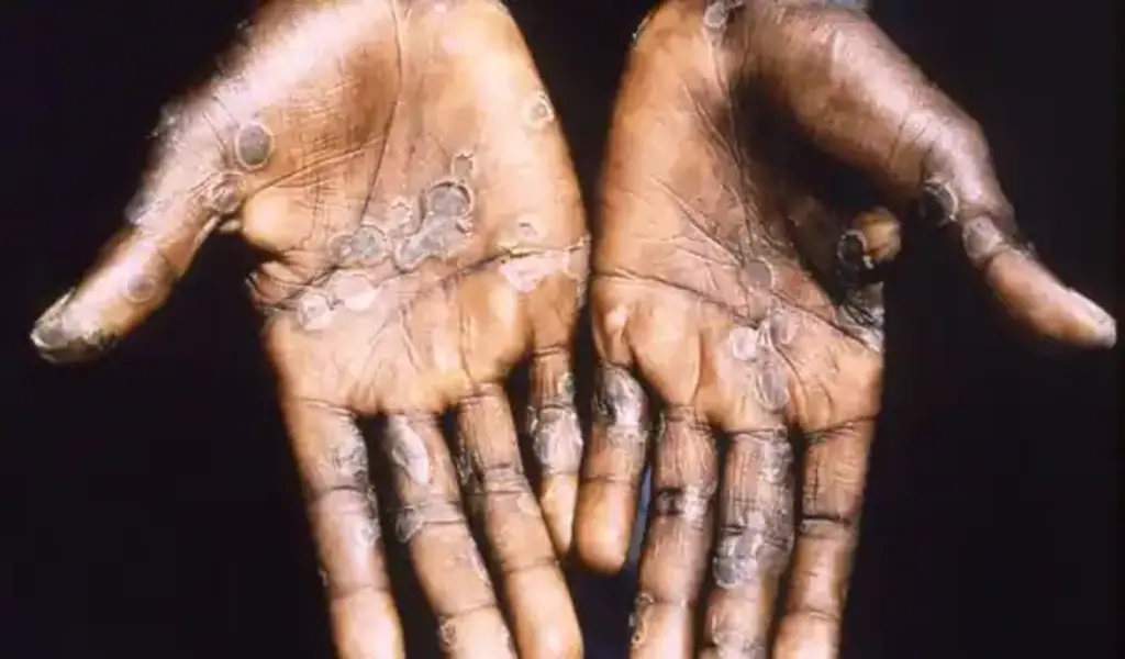 Monkeypox Cases In UK Crosses 1000-Mark, Europe Accounts For 86% Of Infections Worldwide