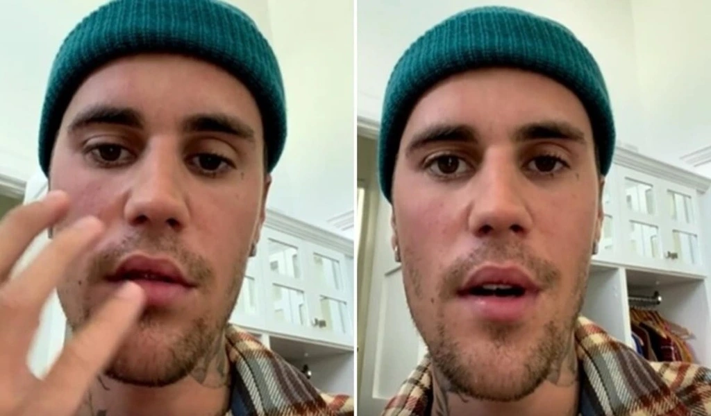 What is Ramsay Hunt Syndrome & Its Symptoms The Virus Attacked On Justin Bieber's Face