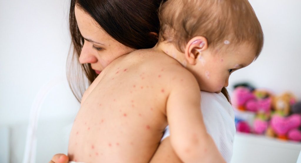 Signs and symptoms of chicken pox