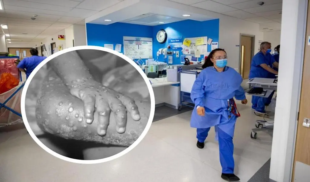 Monkeypox Cases Are Beginning To Plateau In The Uk 156 Monkeypox Cases Are Beginning To Plateau In The UK