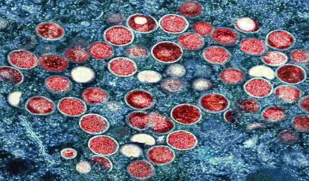U-M Experts Discuss Monkeypox Symptoms &Amp; Spread 155 U-M Experts Discuss Monkeypox Symptoms & Spread