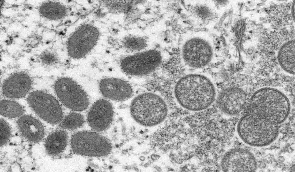 One More Person in the U.S. Dies After Contracting Monkeypox