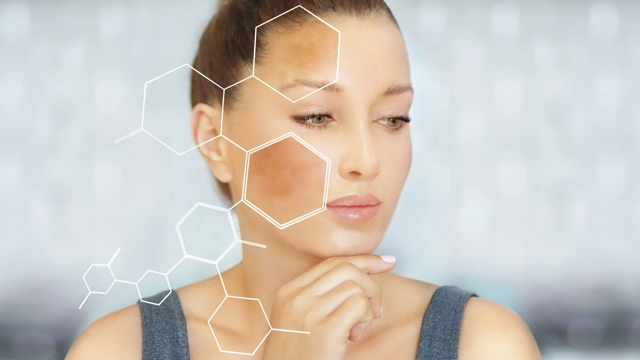 Understanding Melasma and How its Treated