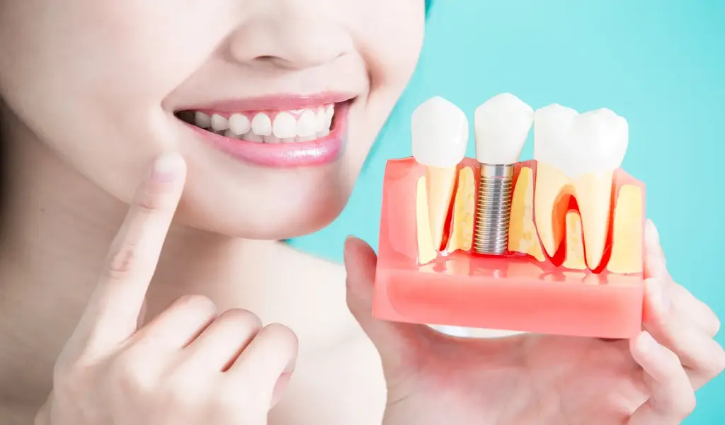 How To Protect Dental Implants So They Last Forever