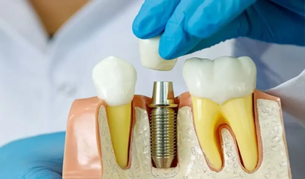 Dental Implant Procedure: What you Should Expect