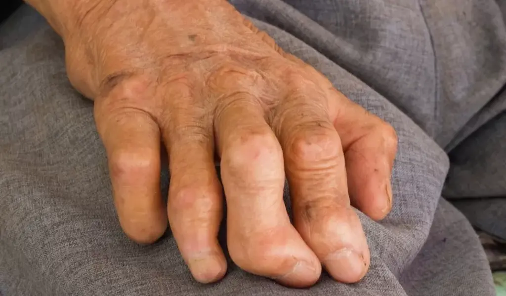 Leprosy: Chronic Disease That Regenerates Organs