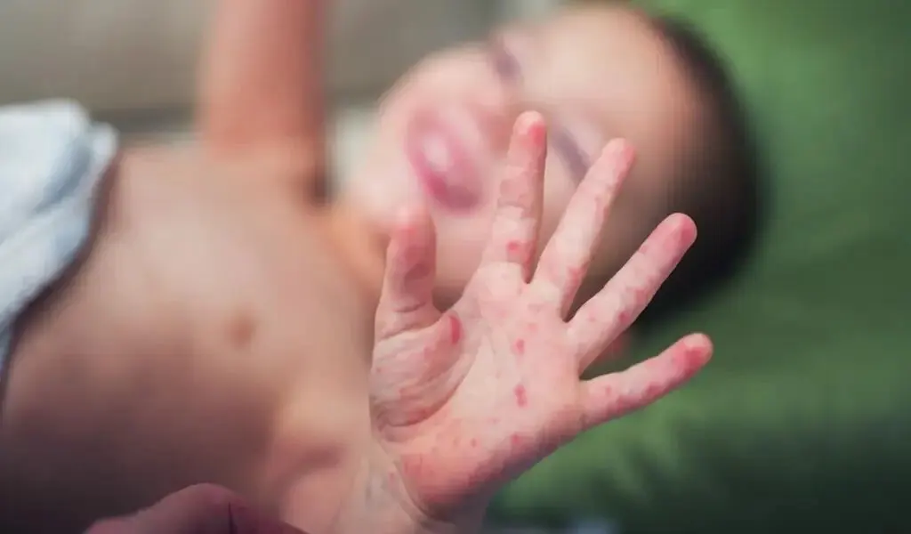 Measles Outbreak In Govandi Prompts BMC To Vaccinate 130 Kids