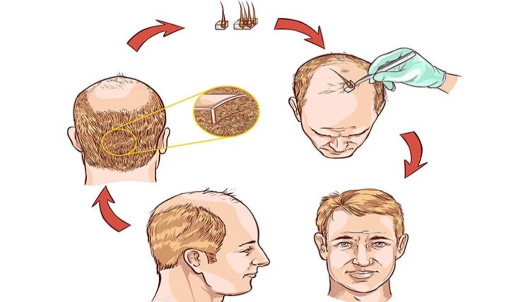 Introduction to Hair Transplant Tourism