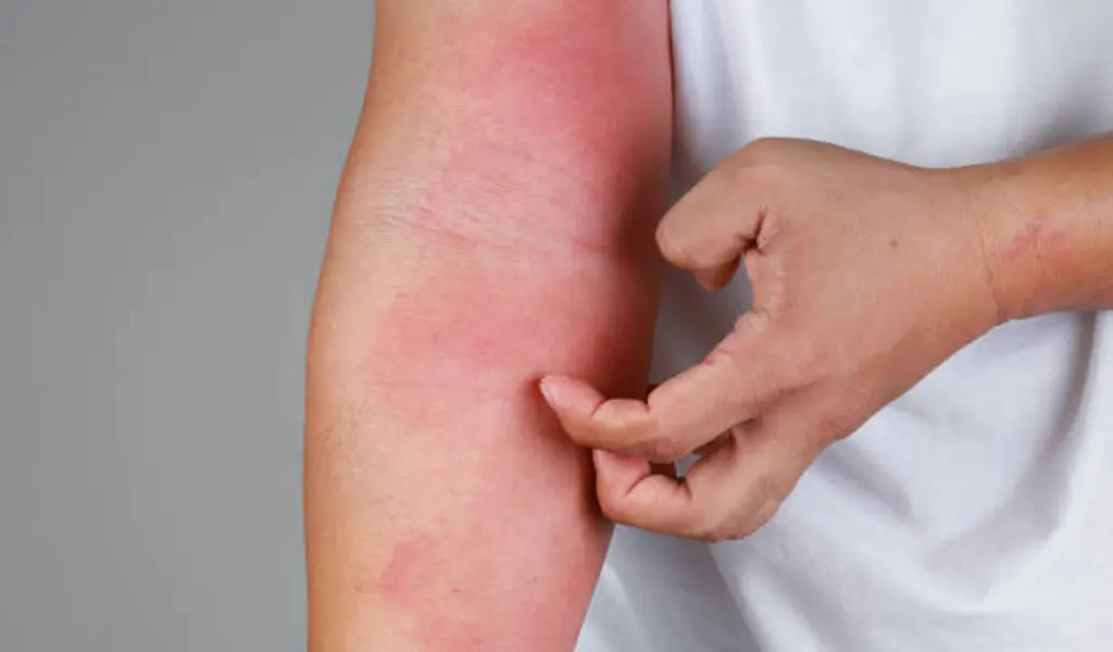 What are the most common causes of skin rashes?