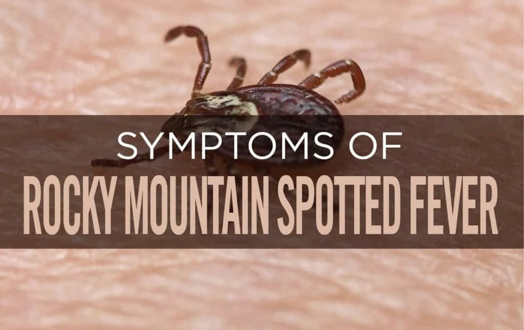 Symptoms of Rocky Mountain Spotted Fever