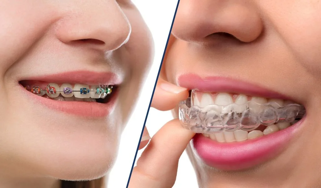 Benefits of Invisalign over Traditional Braces