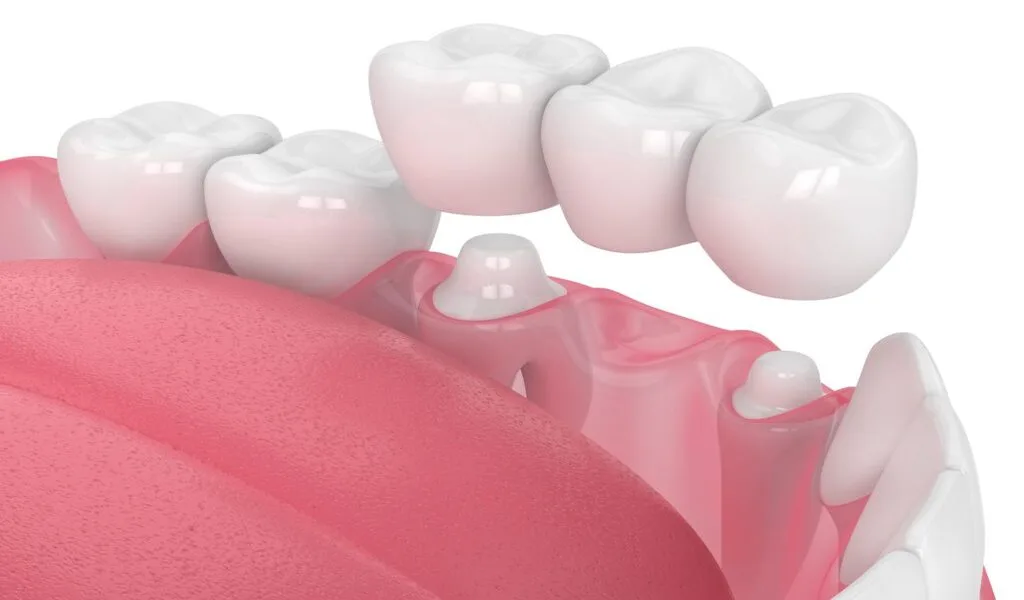 Do I Need a Dental Crown or a Bridge?