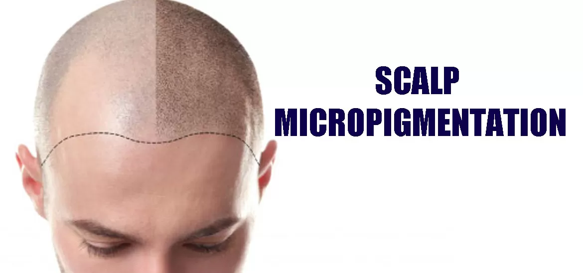 Scalp Micro Pigmentation