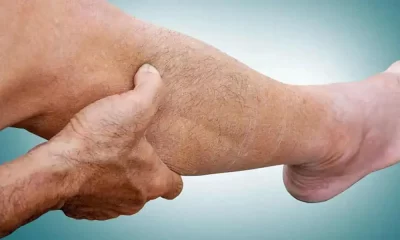 Use Of Smokeless Tobacco Linked To Peripheral Artery Disease