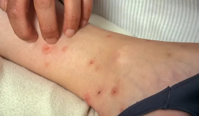 How Do You Treat Bed Bug Bites on Humans?