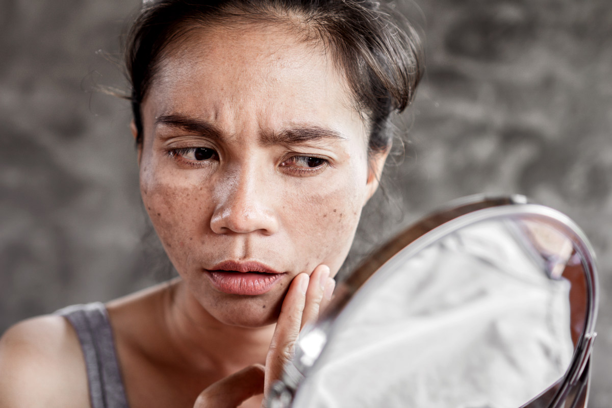 Cosmetic Dermatologist Explains 7 Ways to Treat Melasma