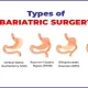 Adult Bariatric Surgery: Benefits And Risks