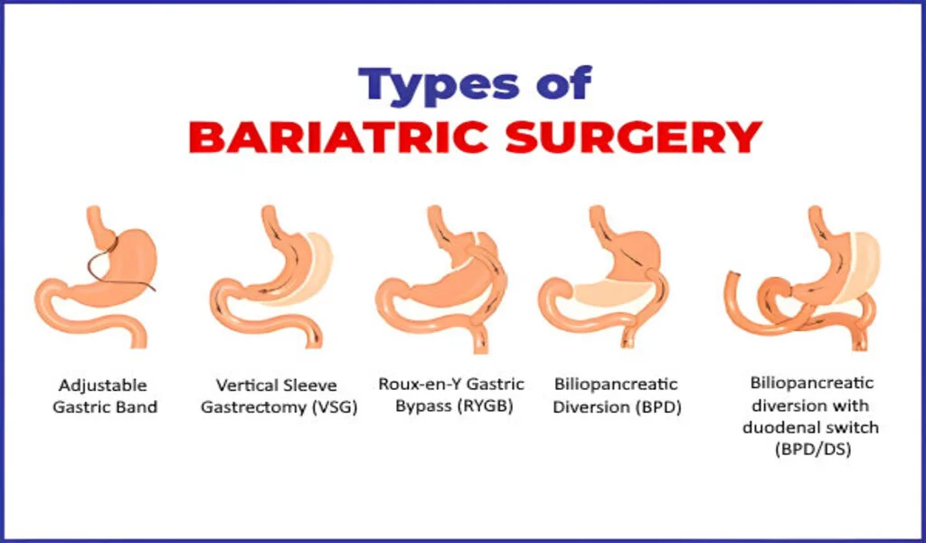 Adult Bariatric Surgery: Benefits And Risks
