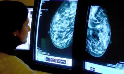 The Most Common Breast Cancer Drug Reduces Recurrence Risk By 25%
