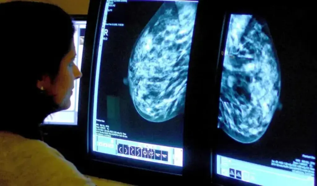 The Most Common Breast Cancer Drug Reduces Recurrence Risk By 25%