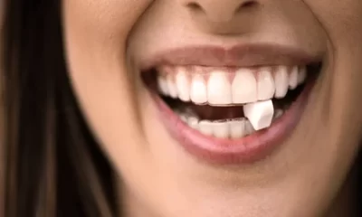 How Do I Know If My Clear Aligners Fit Properly?
