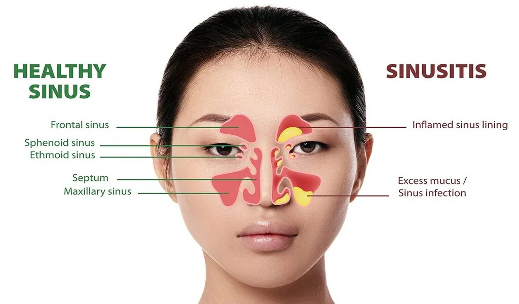 What You Need To Know About Sinus Infections And How To Treat Them