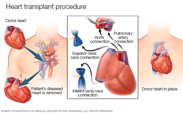 mcdc heart transplant surgery 8col