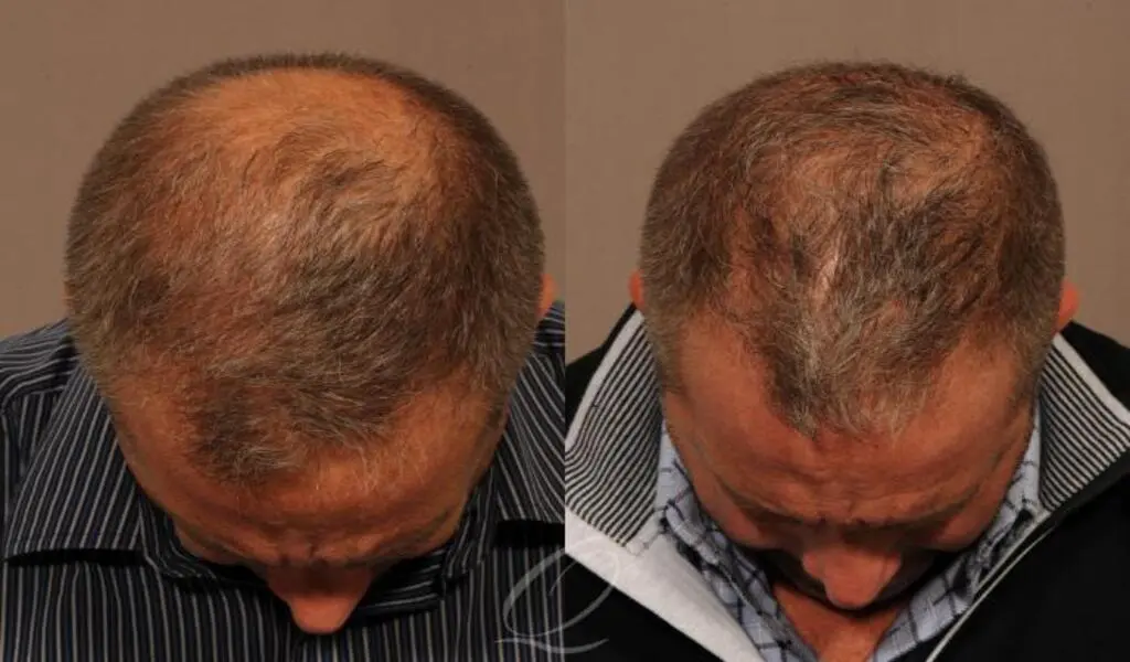 FUE vs Traditional Hair Transplant Choosing the Right Technique for Your Hair Restoration