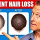 How to Prevent Hair Loss While Taking Testosterone: Tips and Strategies to Keep Your Hair Healthy