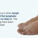 Lymphedema, Symptoms and How Physical Therapy Can Help