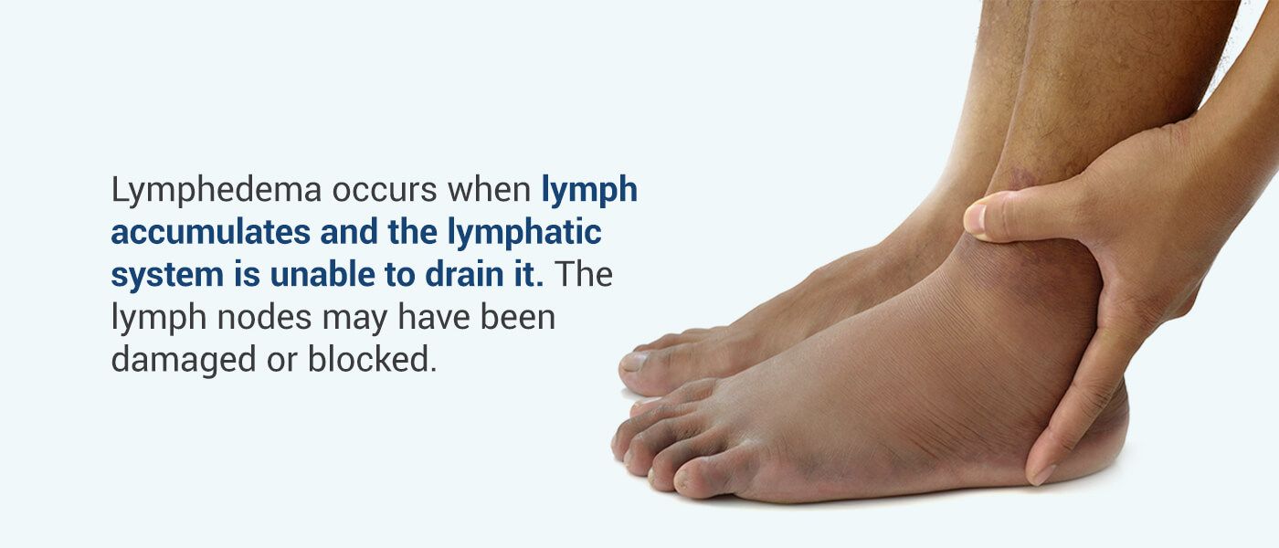 Lymphedema, Symptoms and How Physical Therapy Can Help