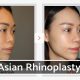Why Turkey is the Top Destination for Asian Rhinoplasty