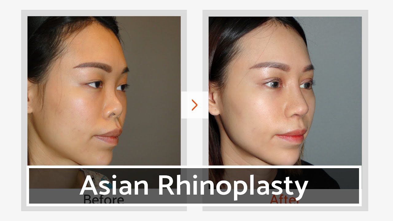 Why Turkey is the Top Destination for Asian Rhinoplasty