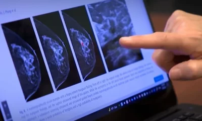 Breast Cancer Screening With AI Is As Good As 2 Radiologists