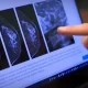 Breast Cancer Screening With AI Is As Good As 2 Radiologists